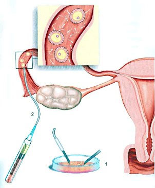 Artificial Insemination artificial insemination in coimbatore