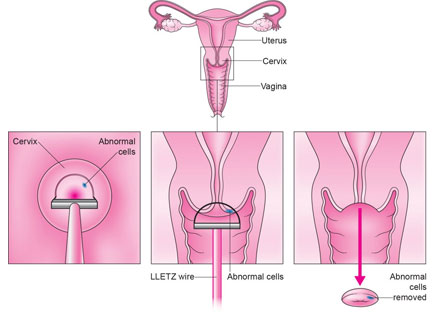 Cervical Cancer Hospital best cervical cancer hospital in india