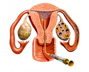 Fertility Hospital best fertility hospital in coimbatore