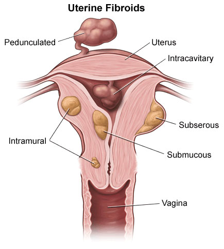 Fibroid Treatment best fibroid operation cost in india