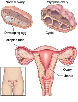 best pcos treatment in coimbatore best pcos treatment in coimbatore
