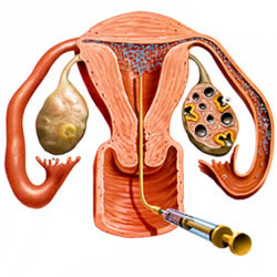 Infertility treatment in India best state for fertility treatment in india