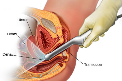 Endometriosis Doctor in India endometriosis doctor in india
