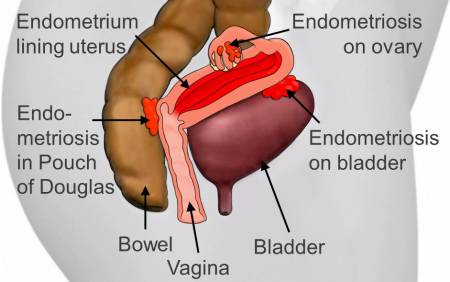 Endometriosis specialist in India Endometriosis specialist in india