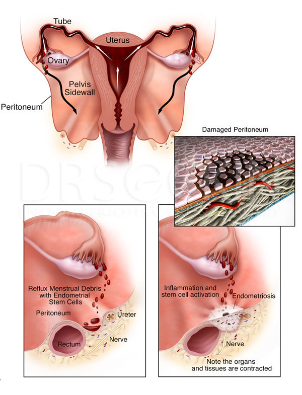 Endometriosis surgeon treatment in india