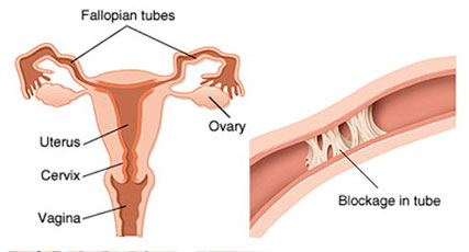 Fallopian Tube Surgery fallopian tube surgery in Tamilnadu