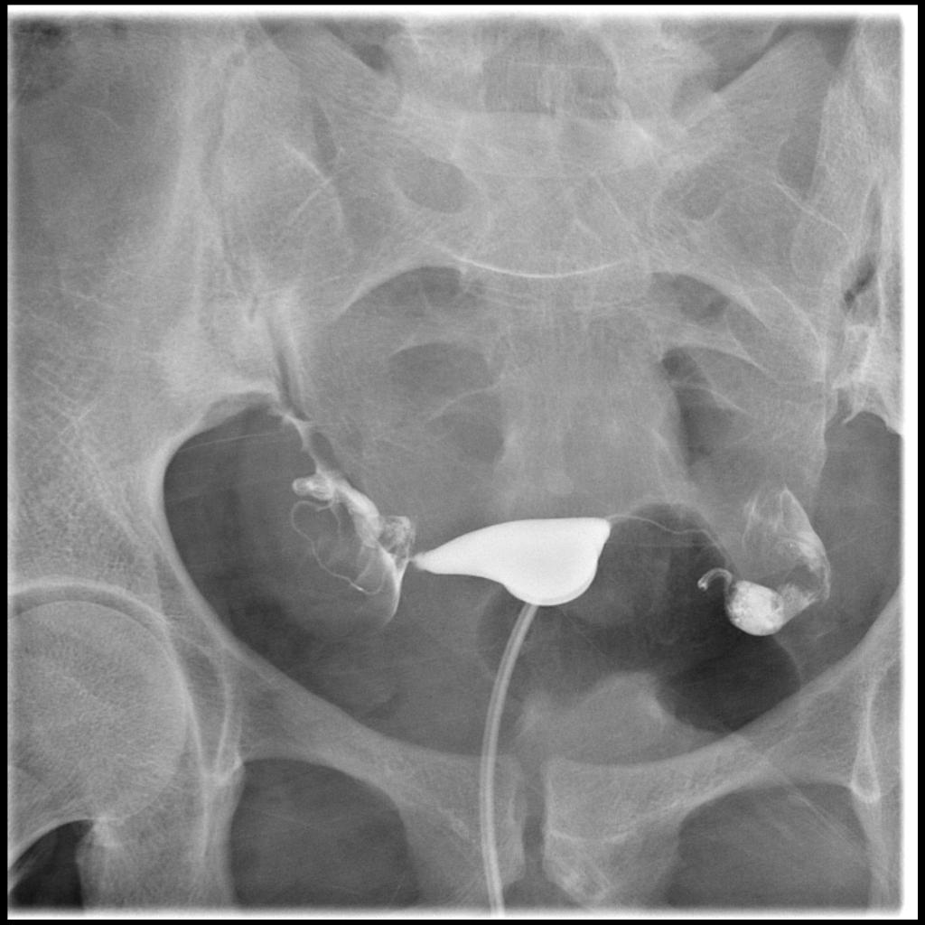HSG Radiology Procedure hsg procedure radiology in Tamilnadu