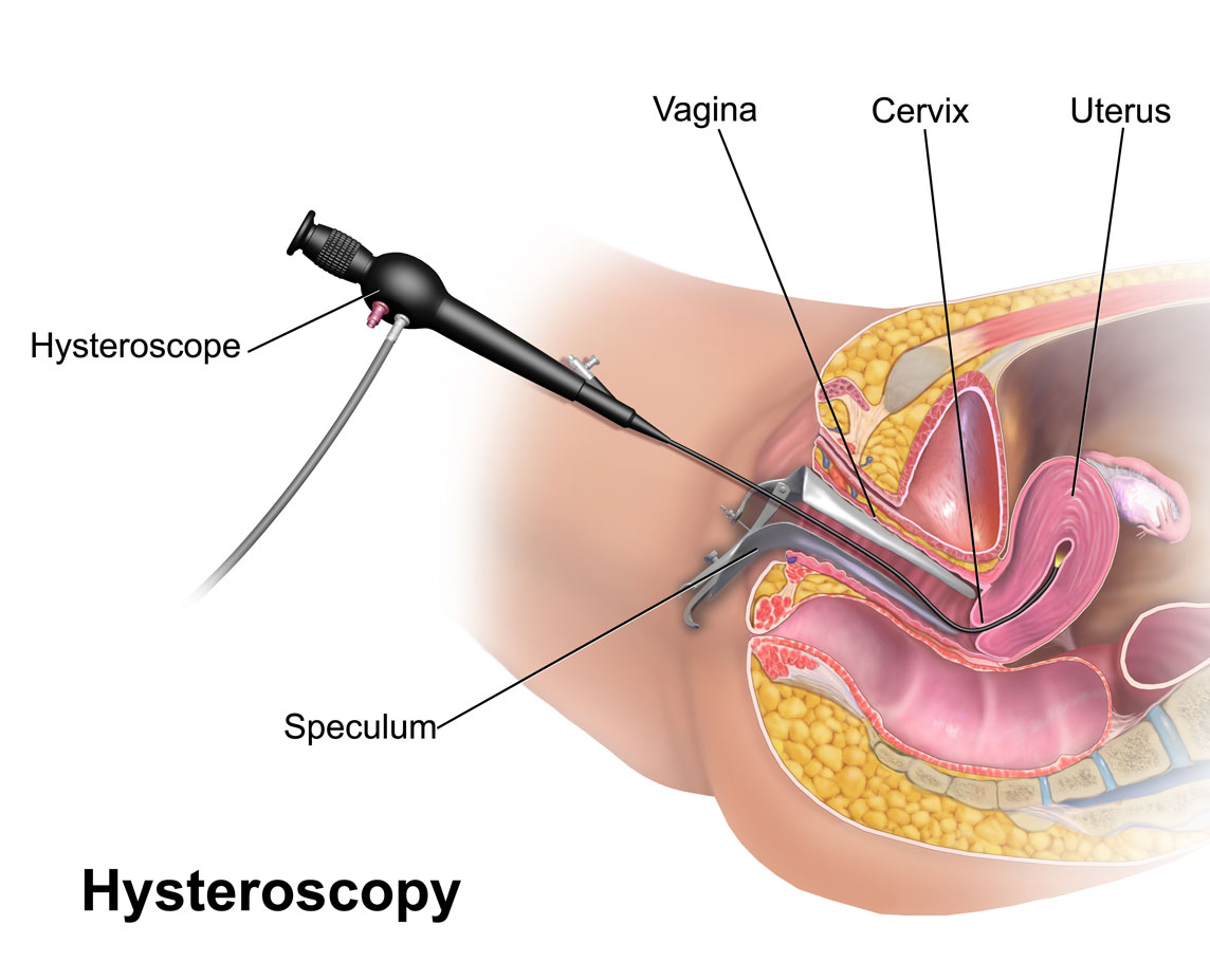 Hysteroscopy Biopsy hysteroscopy biopsy coimbatore
