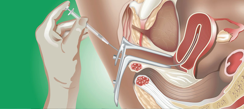 iui treatment in Tamilnadu