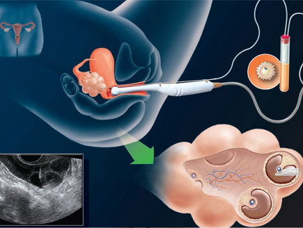 IVF Treatment ivf cost in india