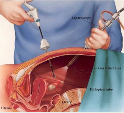 ="Laparoscopic Laparoscopic Surgery cost in coimbatore
