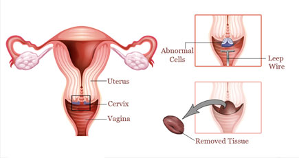 Leep Cancer Treatment leep cancer treatment in india