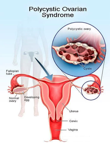 ovarian drilling treatment cost in india
