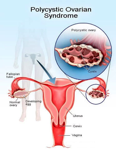 Ovarian Drilling Treatment in India ovarian drilling treatment cost in india
