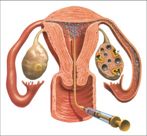 Ovulation Induction Treatment treatment for ovulation induction in tamilnadu