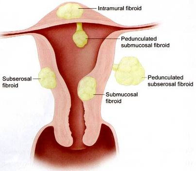 Fibroid operation-cost in india