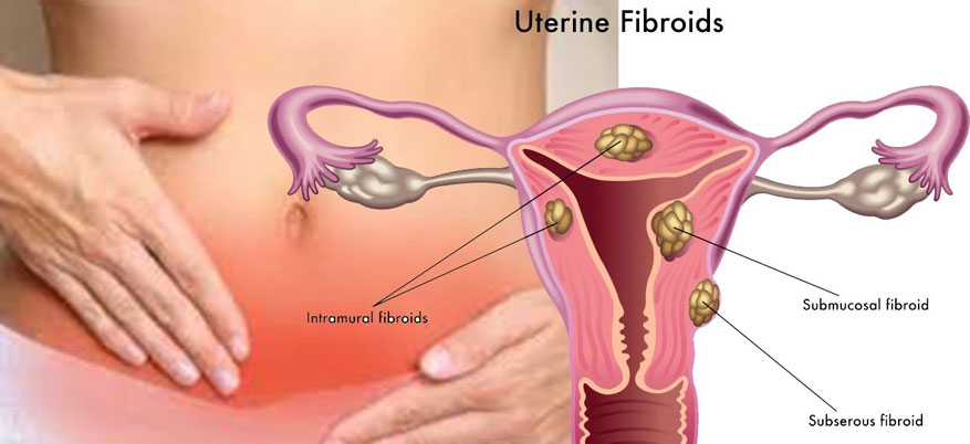uterine Fibroidss treatment in tamilnadu