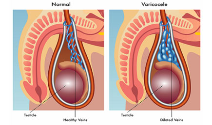 Varicocele Treatment varicocele surgery cost in india