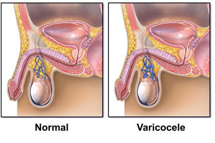 Varicocele Surgery varicocele surgery in india